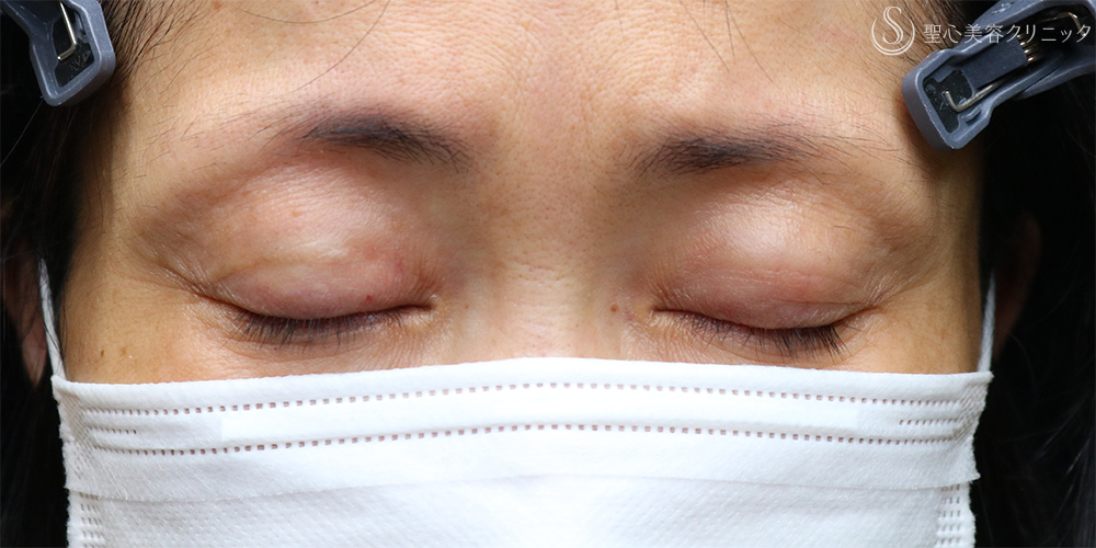 【50代女性・目の上の窪みを整えて、やさしい印象へ】プレミアムPRP皮膚再生療法（目の上）（2年後） Before 
