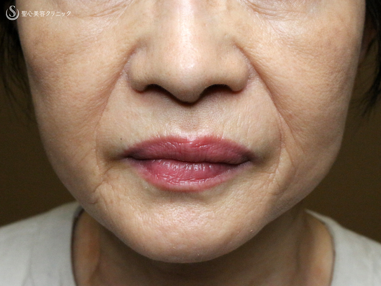 【69歳女性・ほうれい線の注入治療】プレミアムPRP皮膚再生療法（3ヶ月後） Before 