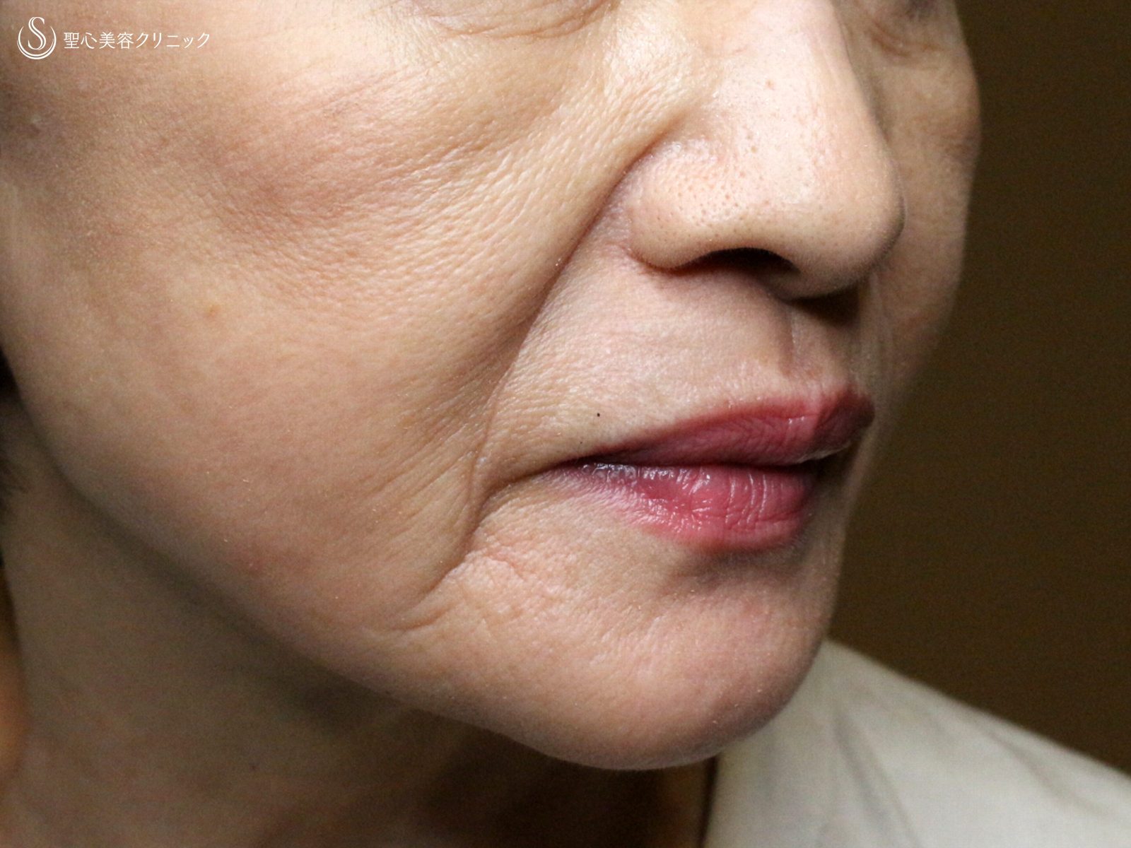 【69歳女性・ほうれい線の注入治療】プレミアムPRP皮膚再生療法（3ヶ月後） Before 