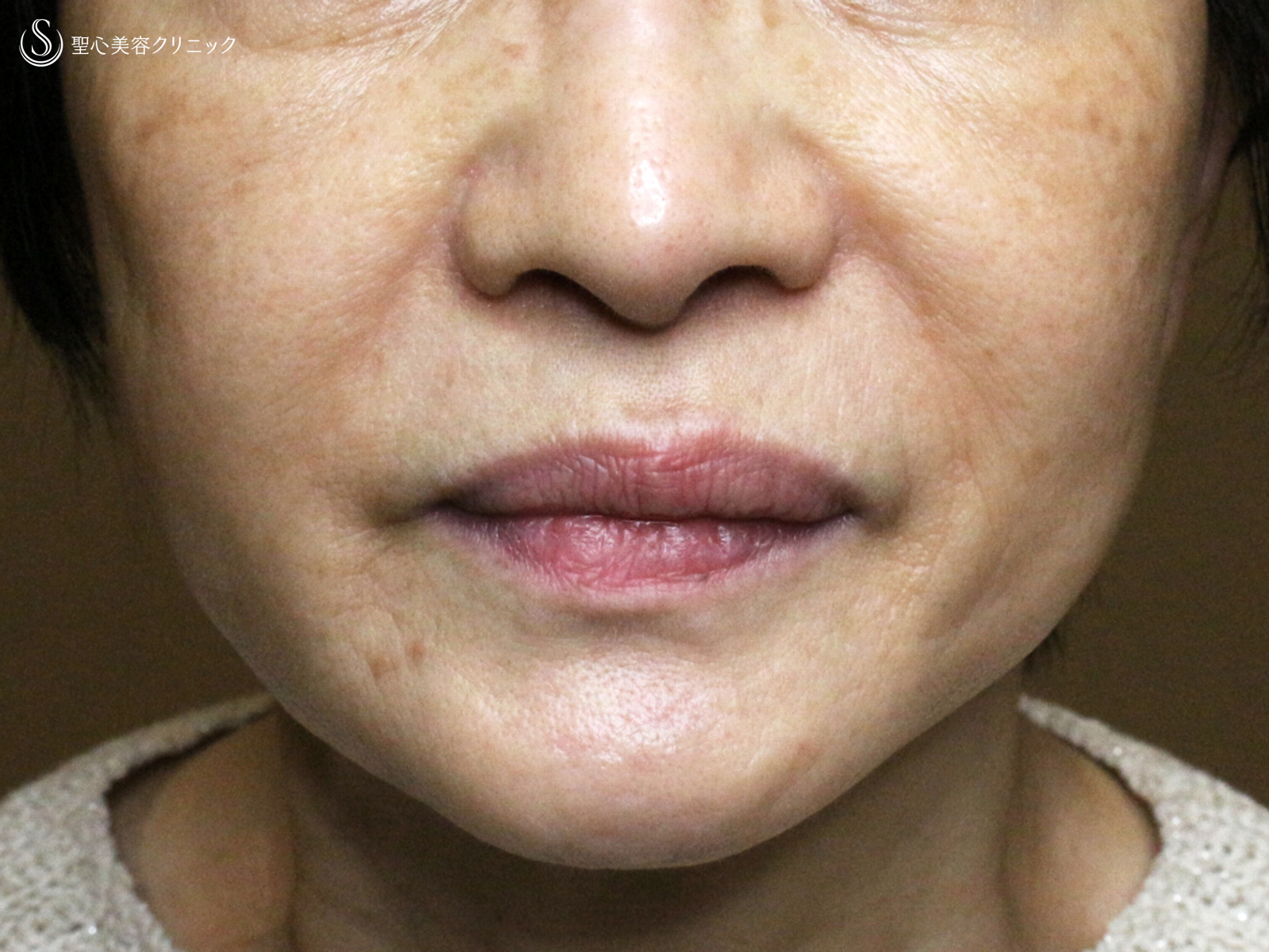 【69歳女性・ほうれい線の注入治療】プレミアムPRP皮膚再生療法（3ヶ月後） After 