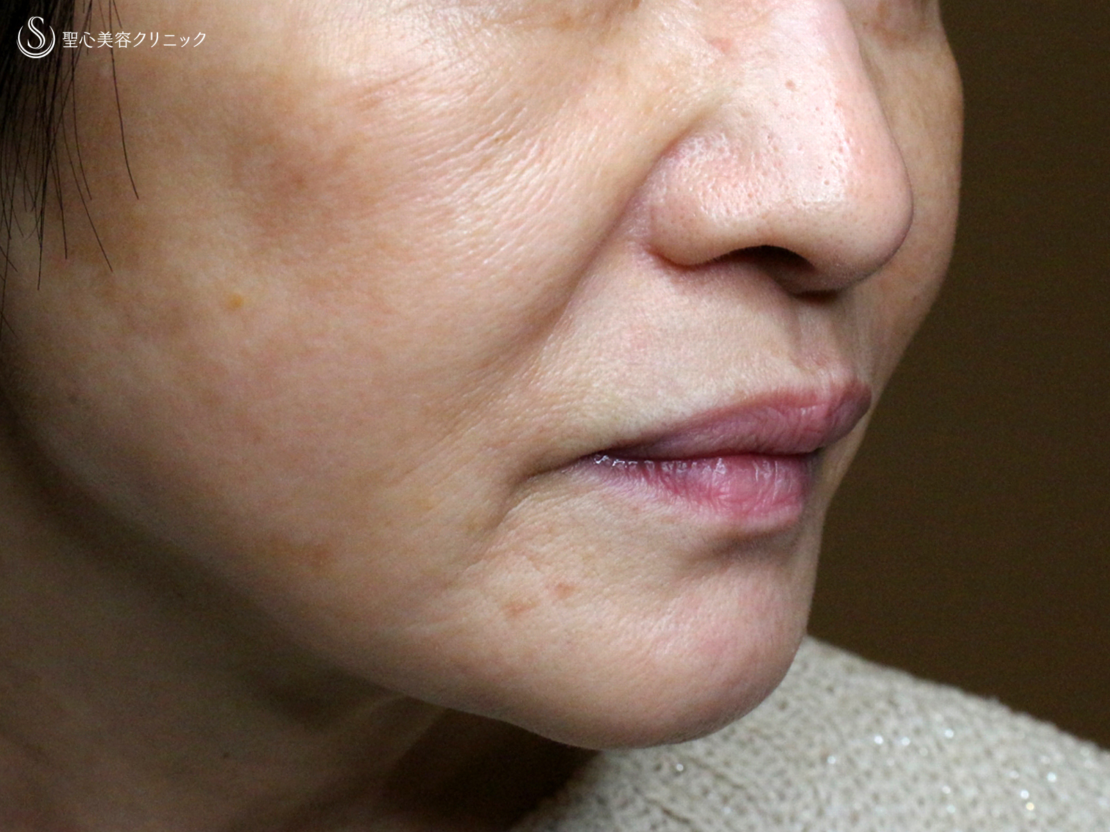 【69歳女性・ほうれい線の注入治療】プレミアムPRP皮膚再生療法（3ヶ月後） After 