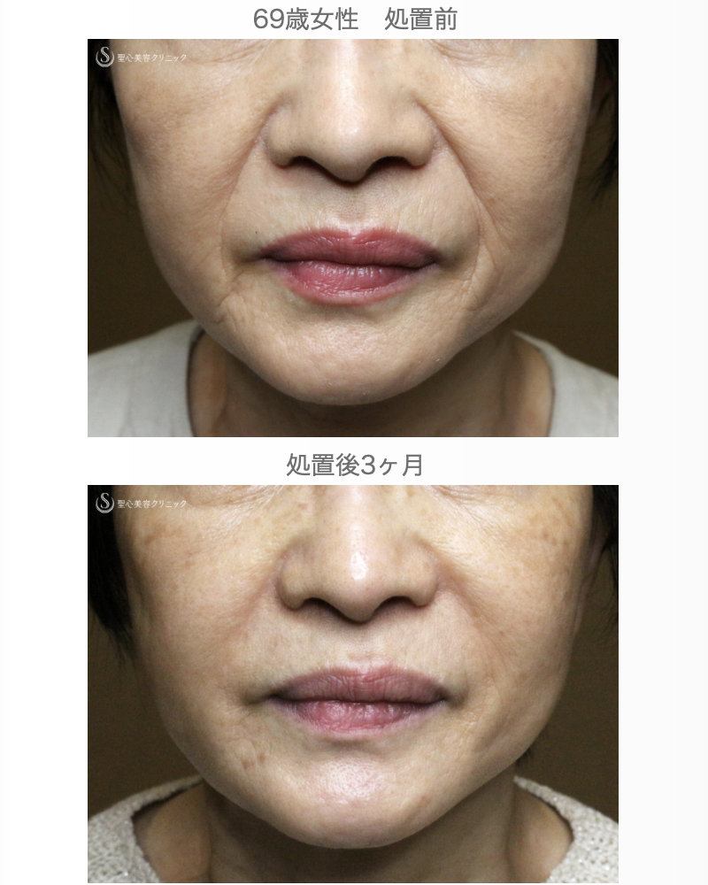【69歳女性・ほうれい線の注入治療】プレミアムPRP皮膚再生療法（3ヶ月後） After 