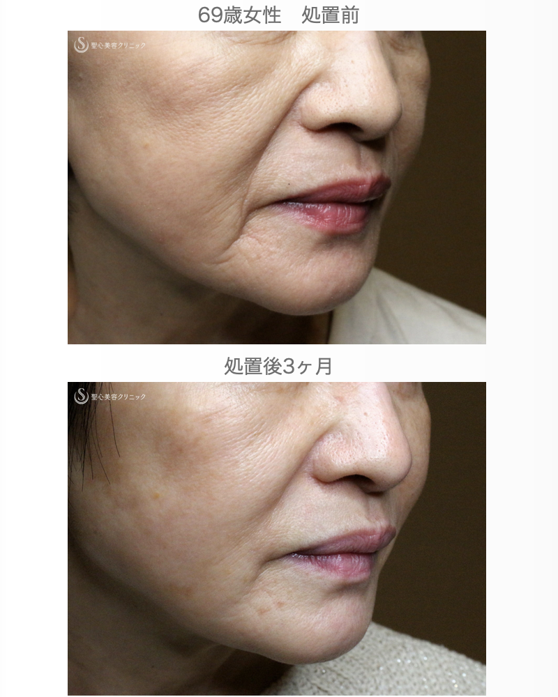 【69歳女性・ほうれい線の注入治療】プレミアムPRP皮膚再生療法（3ヶ月後） After 