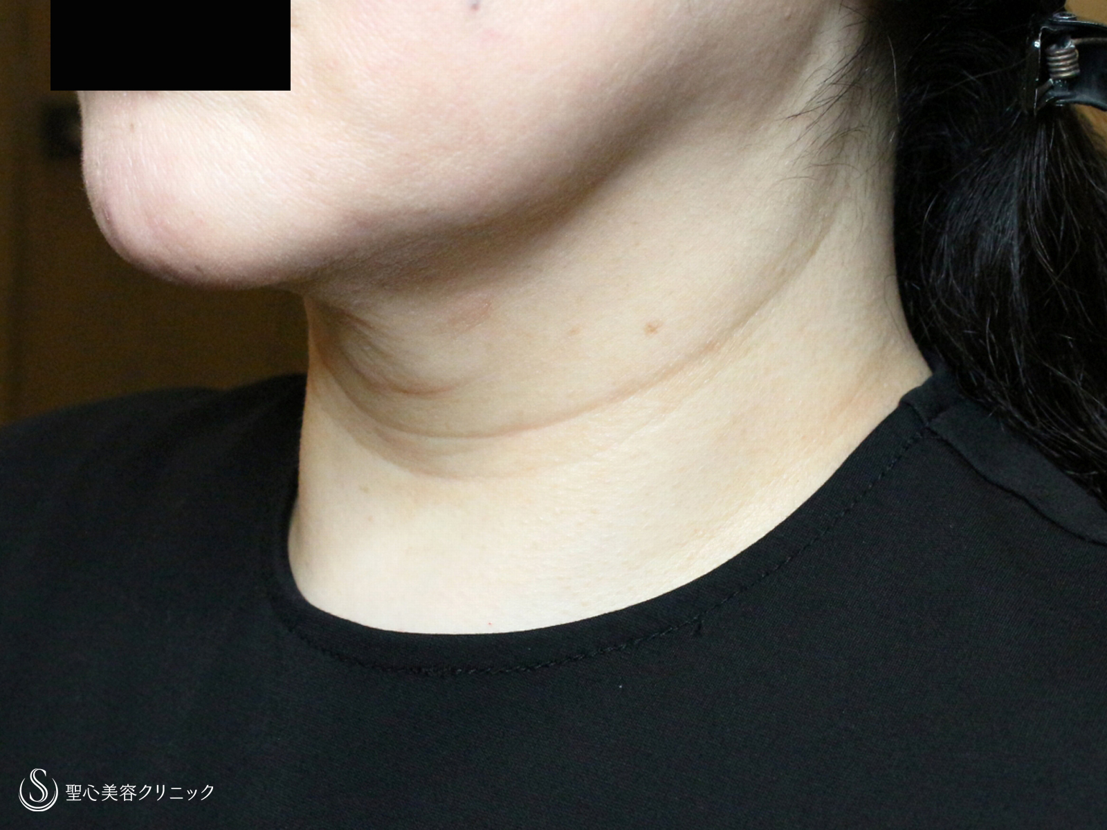 【50代女性・首のシワを綺麗にする】プレミアムPRP皮膚再生療法（1ヶ月後） Before 