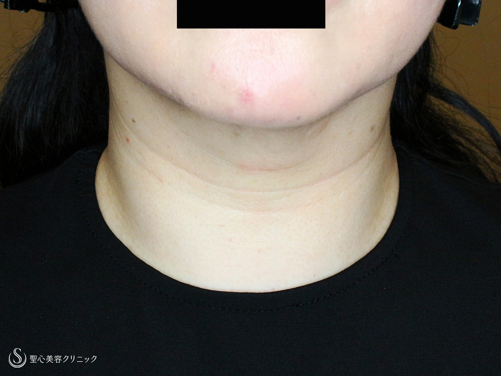 【50代女性・首のシワを綺麗にする】プレミアムPRP皮膚再生療法（1ヶ月後） Before 