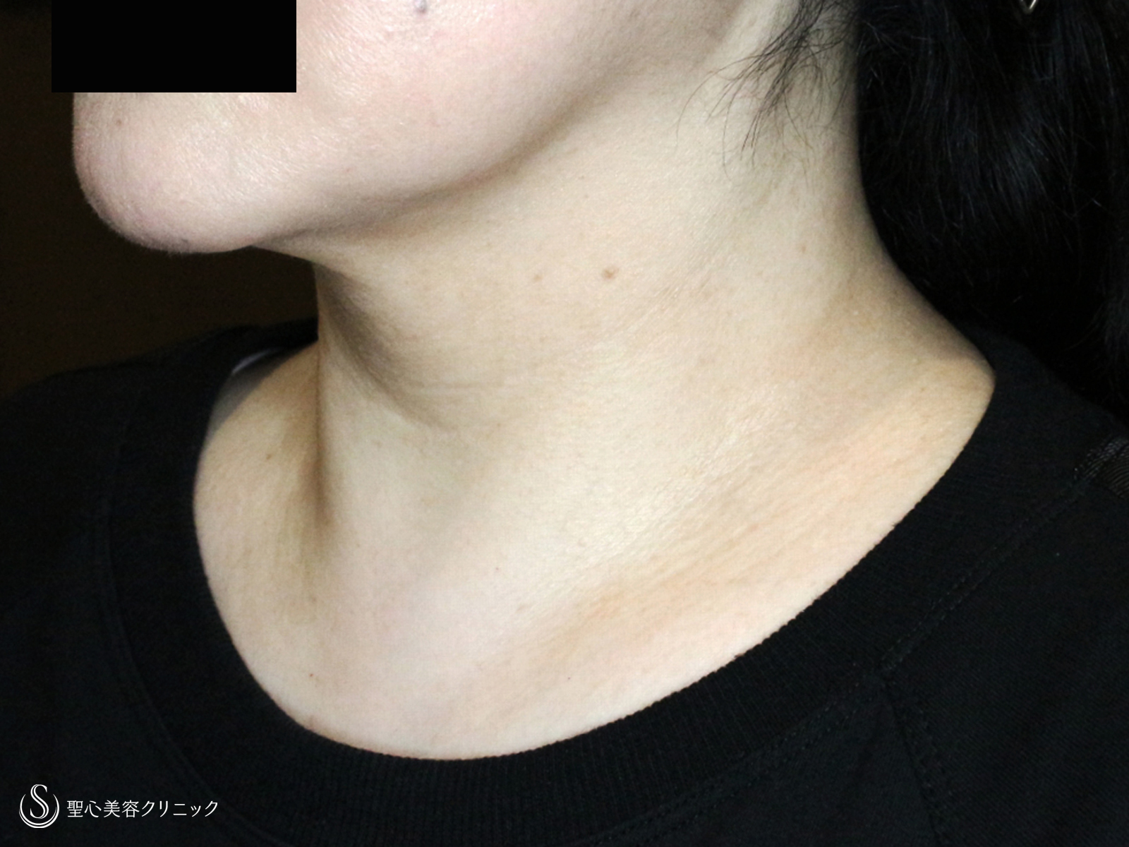 【50代女性・首のシワを綺麗にする】プレミアムPRP皮膚再生療法（1ヶ月後） After 