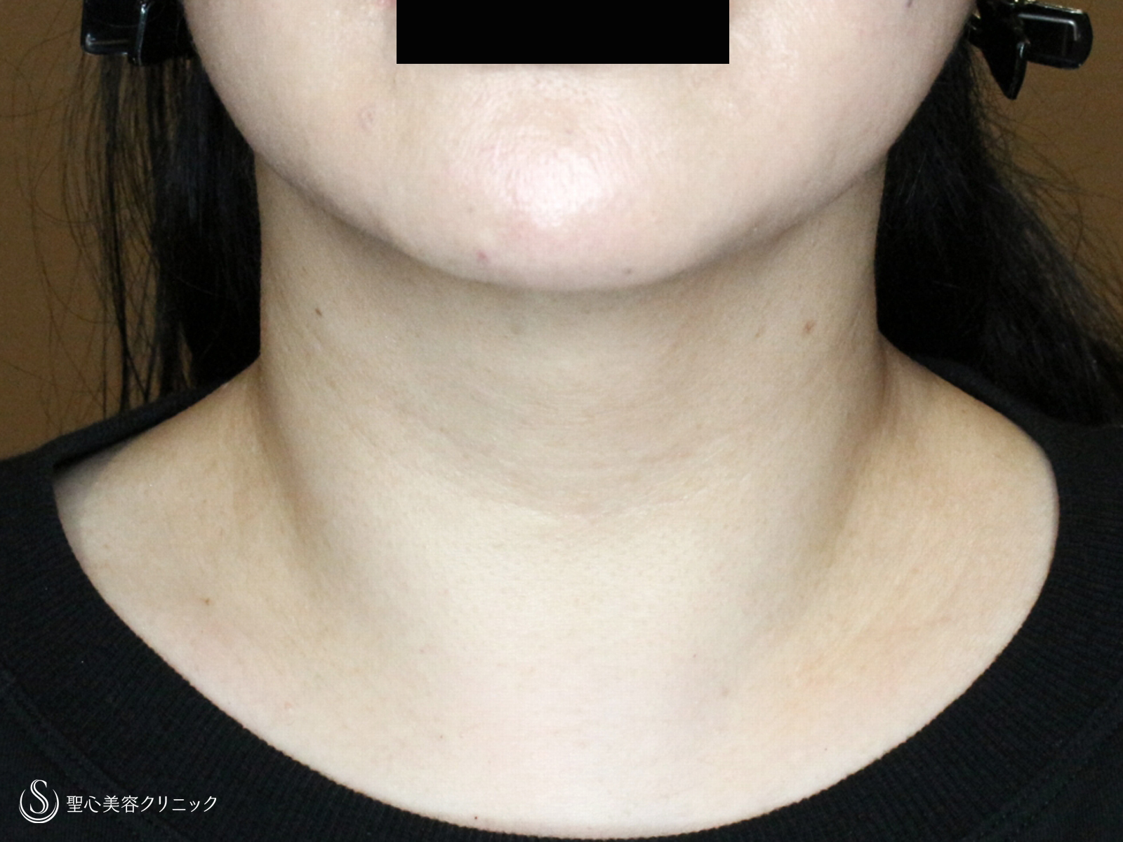 【50代女性・首のシワを綺麗にする】プレミアムPRP皮膚再生療法（1ヶ月後） After 