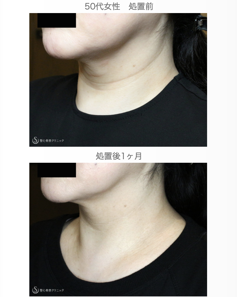 【50代女性・首のシワを綺麗にする】プレミアムPRP皮膚再生療法（1ヶ月後） After 