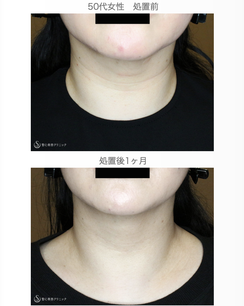 【50代女性・首のシワを綺麗にする】プレミアムPRP皮膚再生療法（1ヶ月後） After 