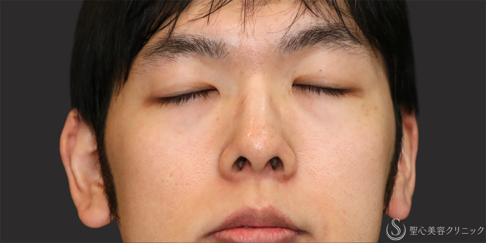 【20代男性・アップノーズを改善】鼻尖縮小（ストラット法）＋鼻尖形成（耳介軟骨移植）（1ヶ月後） Before 