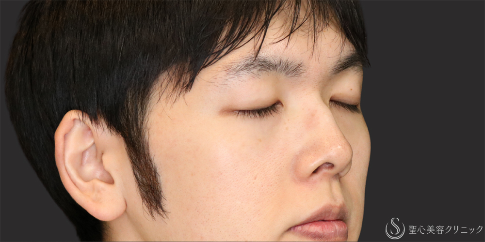 【20代男性・アップノーズを改善】鼻尖縮小（ストラット法）＋鼻尖形成（耳介軟骨移植）（1ヶ月後） Before 