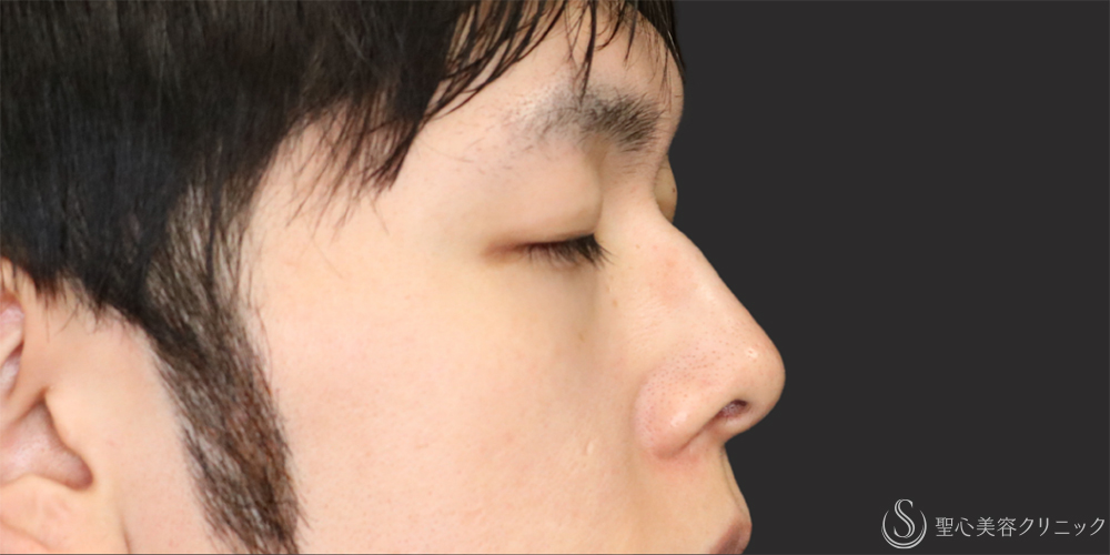 【20代男性・アップノーズを改善】鼻尖縮小（ストラット法）＋鼻尖形成（耳介軟骨移植）（1ヶ月後） Before 