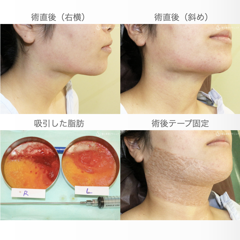 【20代女性・綺麗なフェイスライン】脂肪吸引注射「あご下」（術直後〜2ヶ月後） Before 