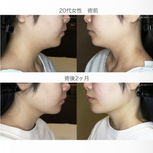 エラ張りの悩みを解決！専門家が教える原因と効果的な方法【エラ張り