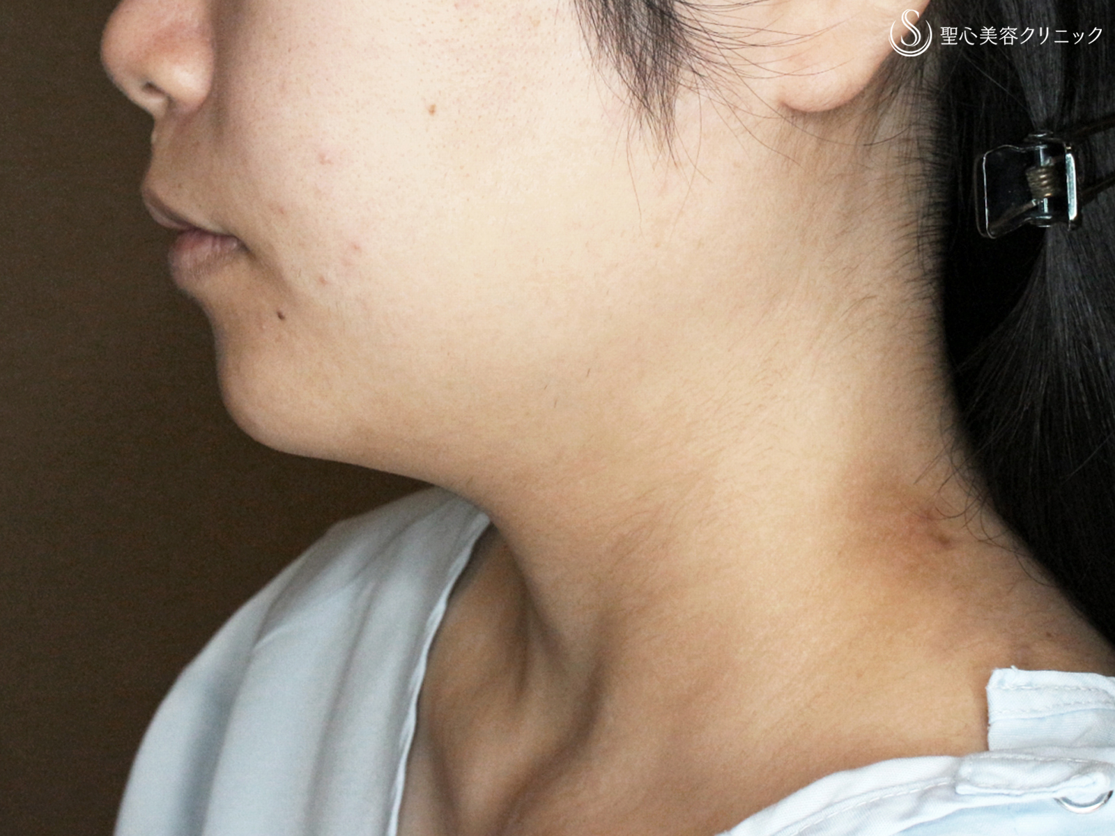 【20代女性・綺麗なフェイスライン】脂肪吸引注射「あご下」（術直後〜2ヶ月後） Before 