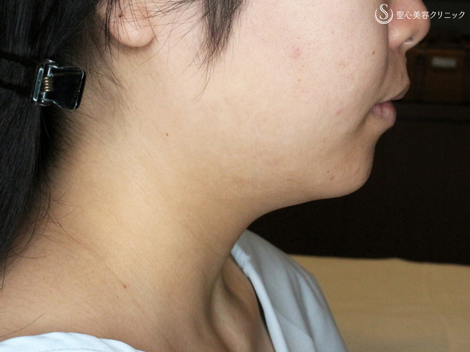 【20代女性・綺麗なフェイスライン】脂肪吸引注射「あご下」（術直後〜2ヶ月後） Before 