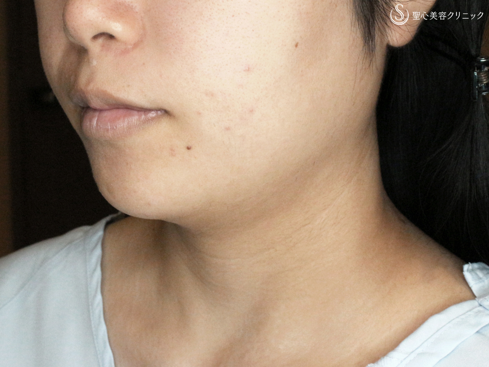 【20代女性・綺麗なフェイスライン】脂肪吸引注射「あご下」（術直後〜2ヶ月後） Before 