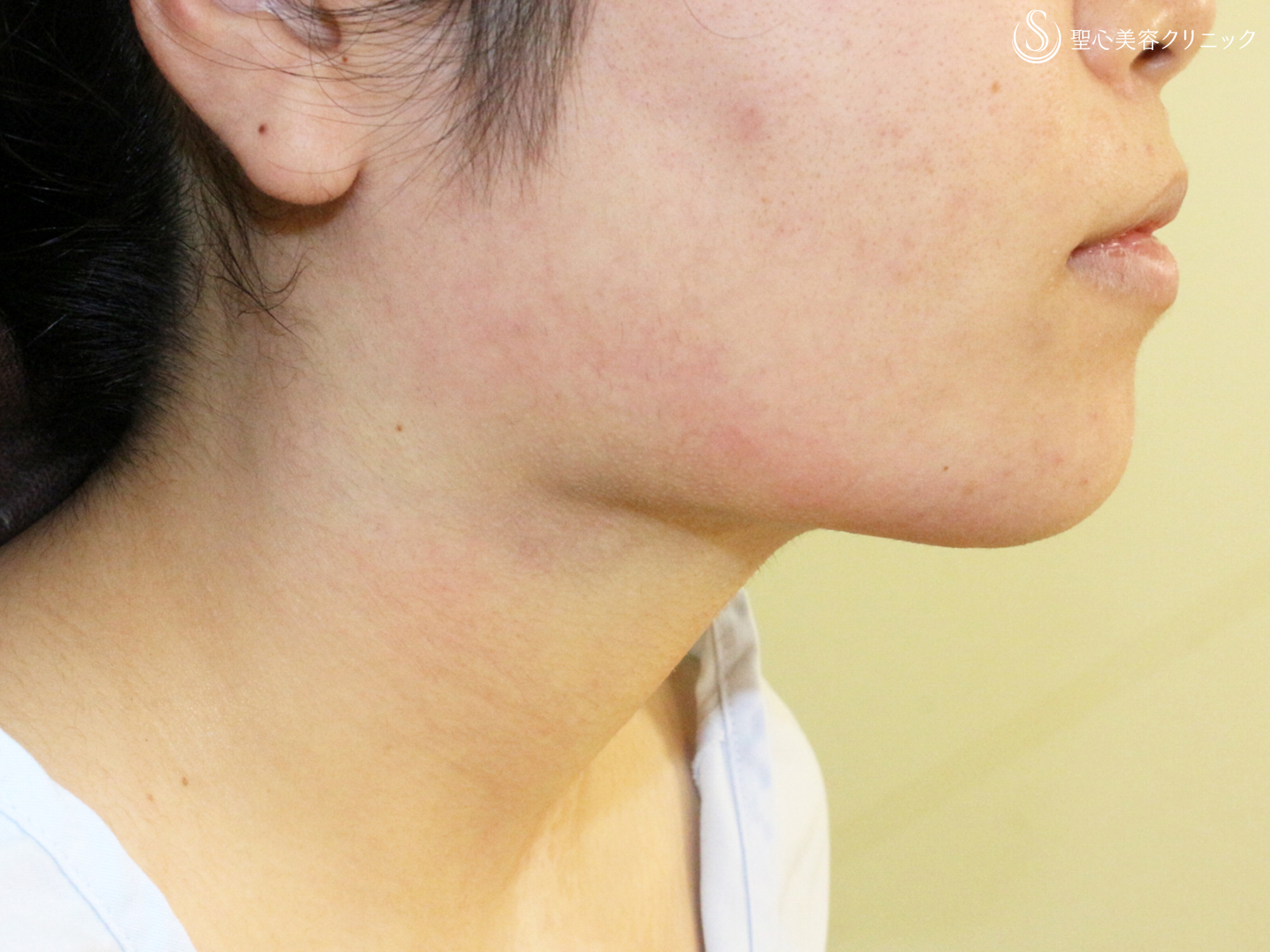 【20代女性・綺麗なフェイスライン】脂肪吸引注射「あご下」（術直後〜2ヶ月後） Before 