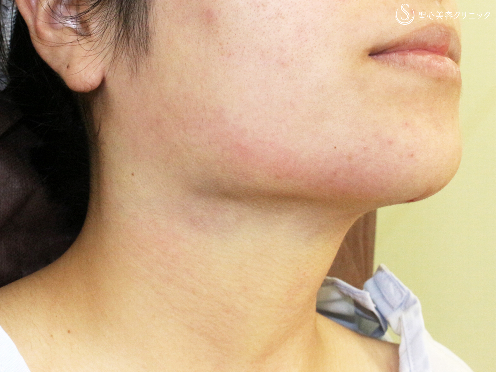 【20代女性・綺麗なフェイスライン】脂肪吸引注射「あご下」（術直後〜2ヶ月後） After 