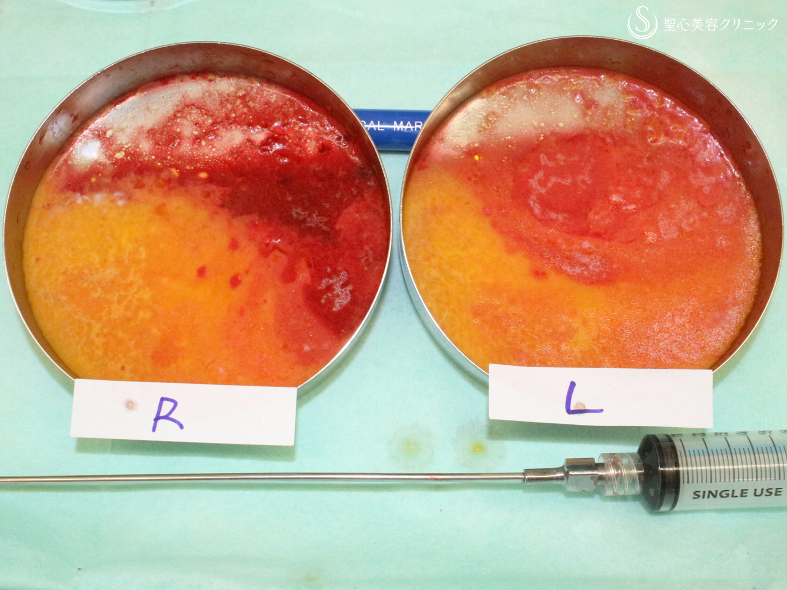 【20代女性・綺麗なフェイスライン】脂肪吸引注射「あご下」（術直後〜2ヶ月後） Before 