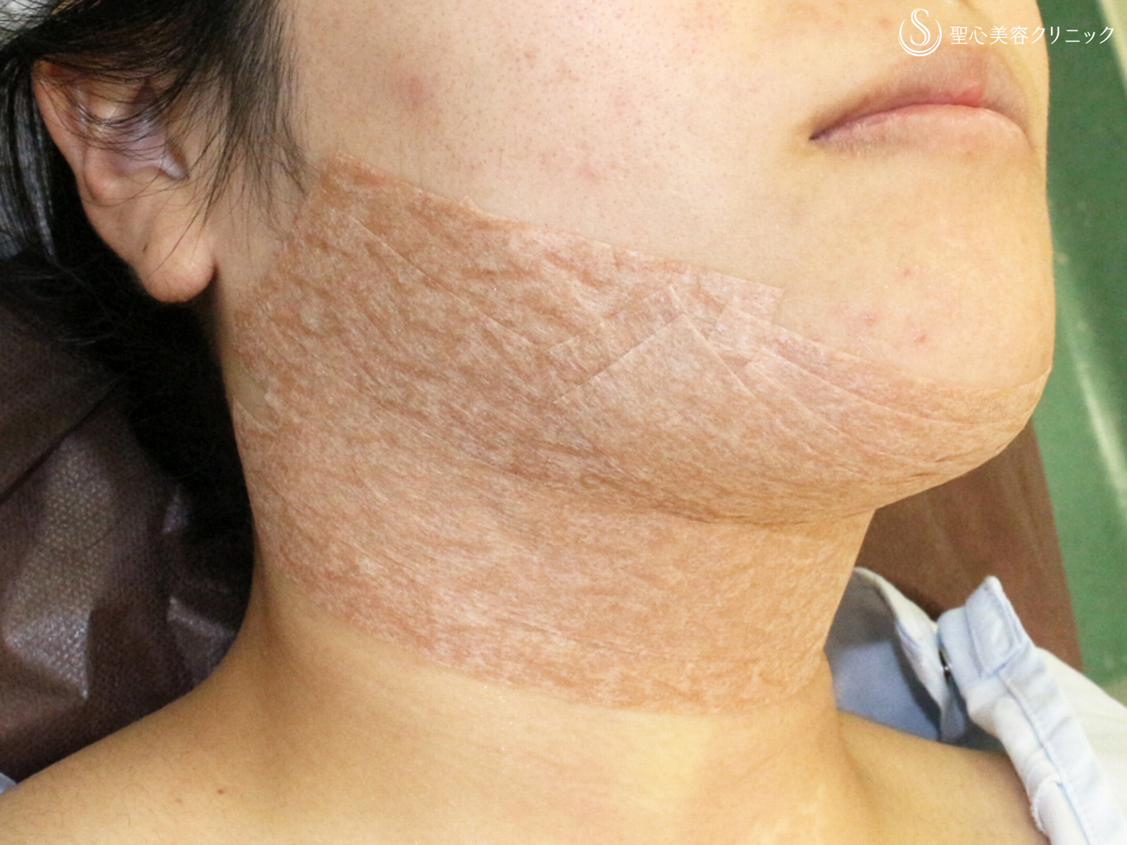 【20代女性・綺麗なフェイスライン】脂肪吸引注射「あご下」（術直後〜2ヶ月後） After 