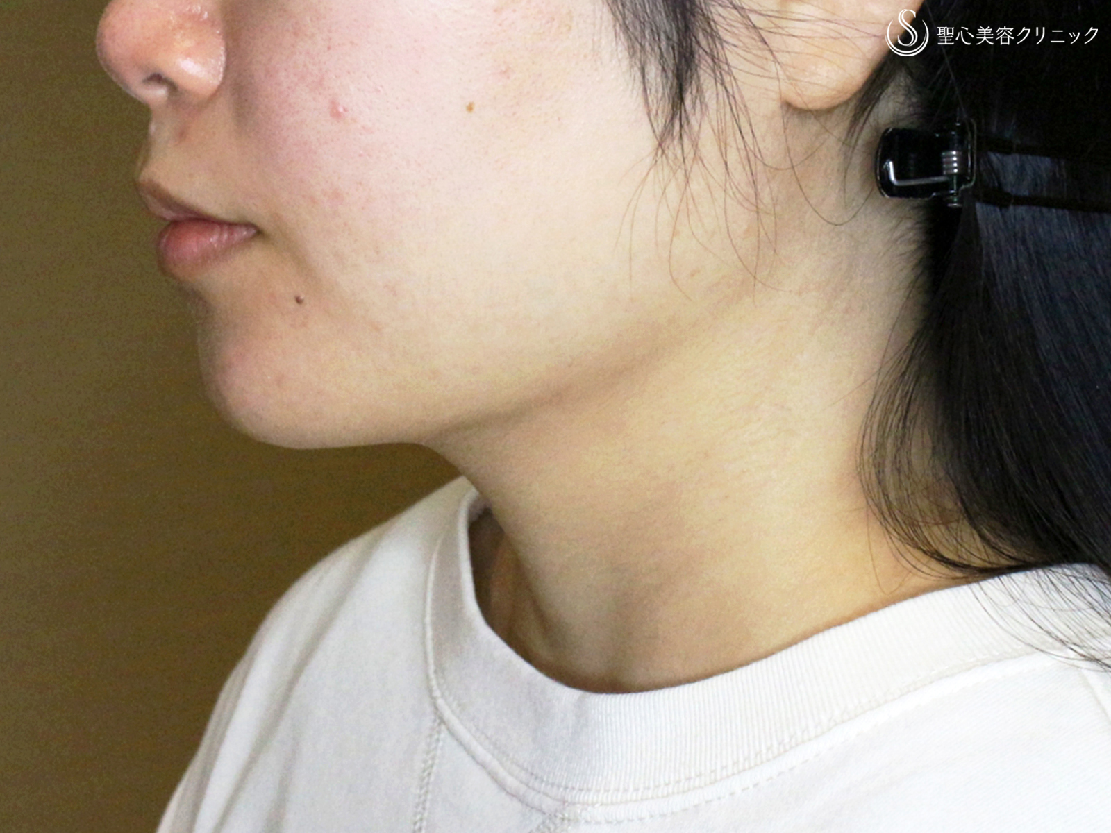 【20代女性・綺麗なフェイスライン】脂肪吸引注射「あご下」（術直後〜2ヶ月後） After 