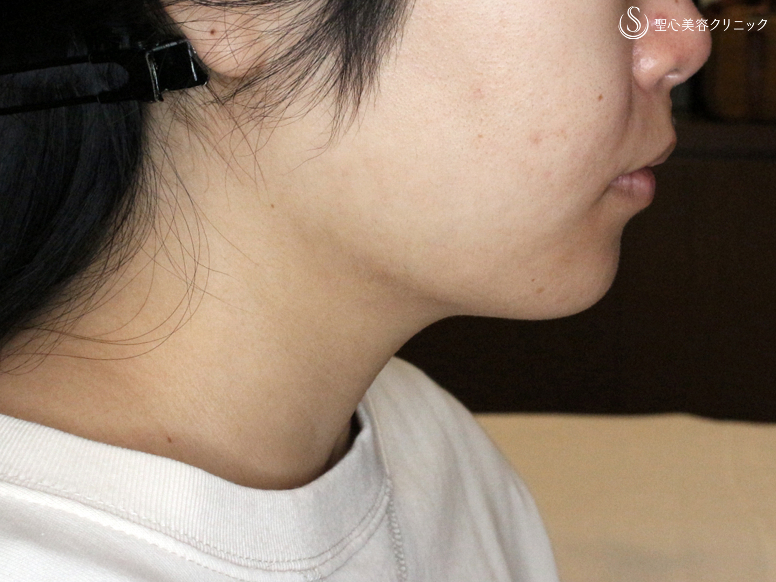 【20代女性・綺麗なフェイスライン】脂肪吸引注射「あご下」（術直後〜2ヶ月後） After 