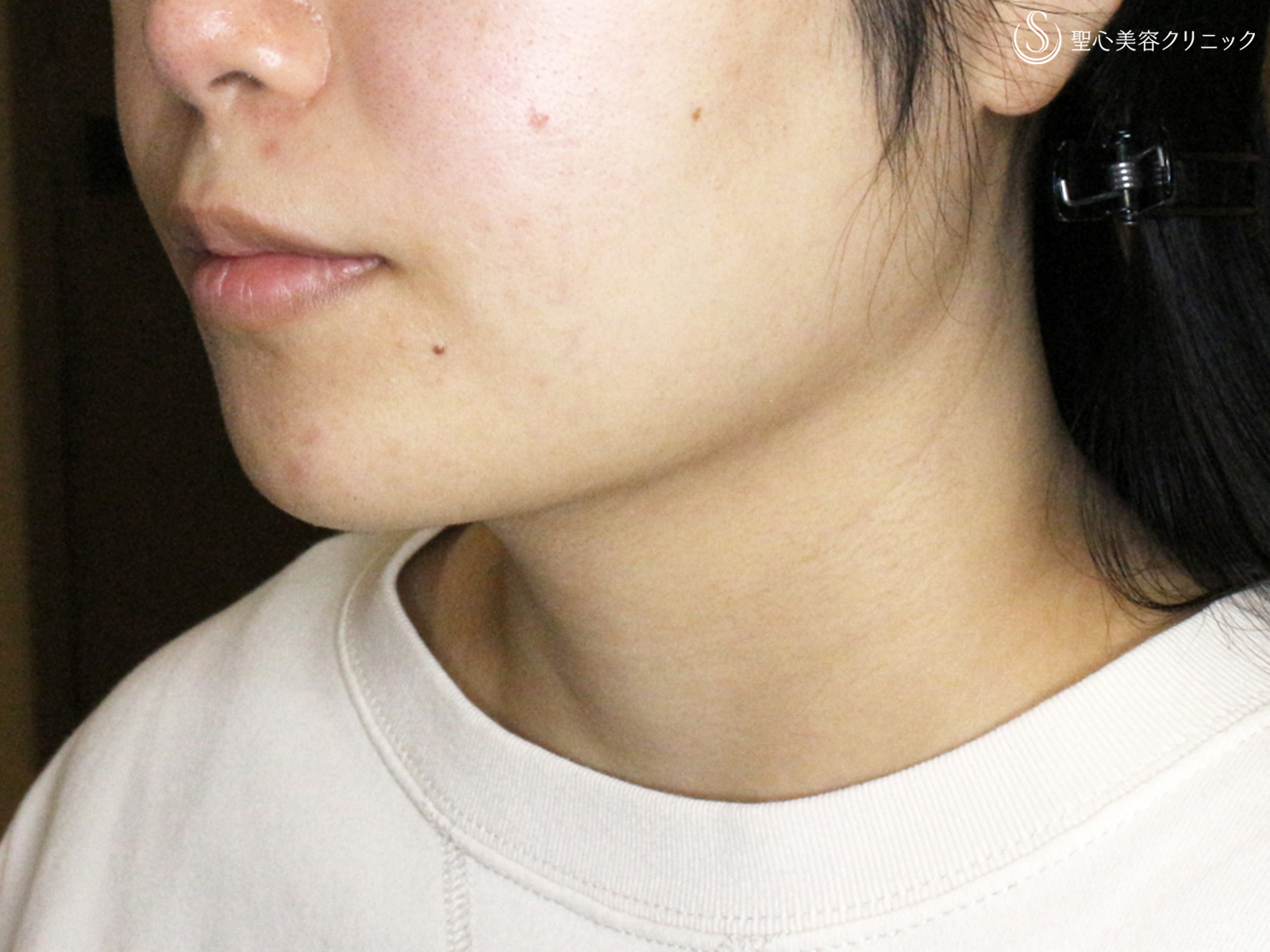 【20代女性・綺麗なフェイスライン】脂肪吸引注射「あご下」（術直後〜2ヶ月後） After 