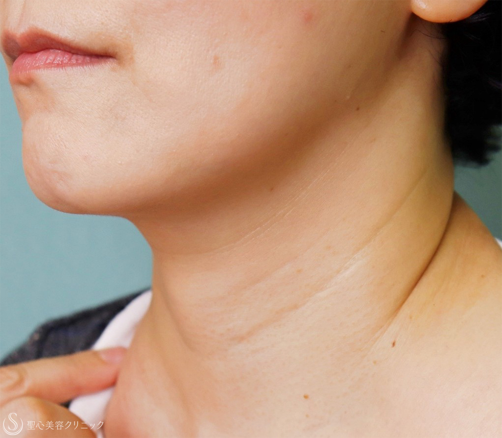 【50代女性・首の横じわ】プレミアムPRP皮膚再生療法（11ヶ月後～5年後） Before 