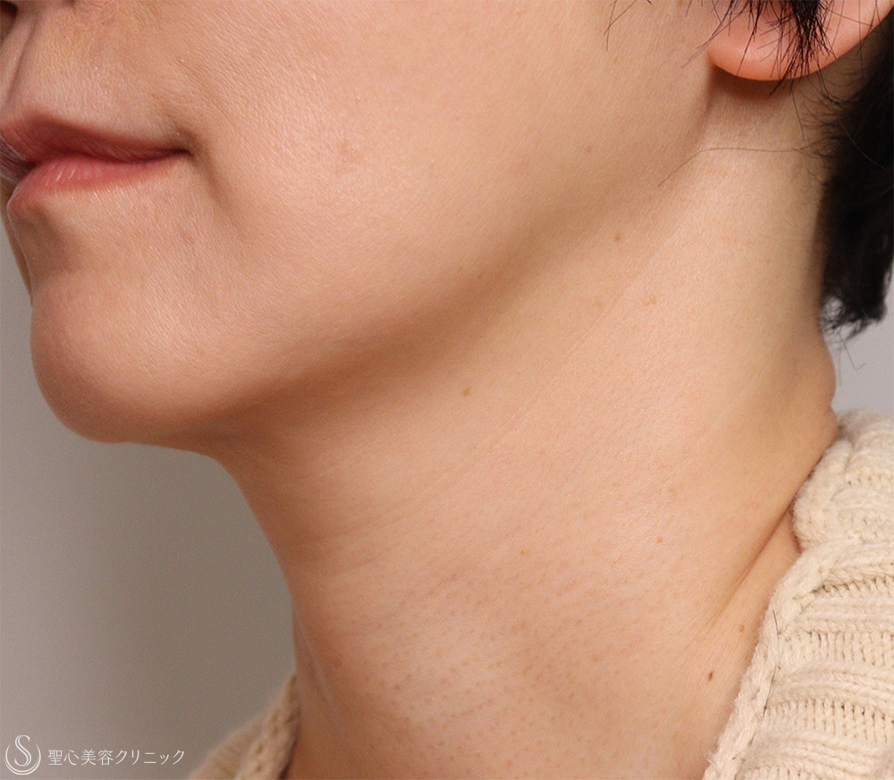 【50代女性・首の横じわ】プレミアムPRP皮膚再生療法（11ヶ月後～5年後） After 