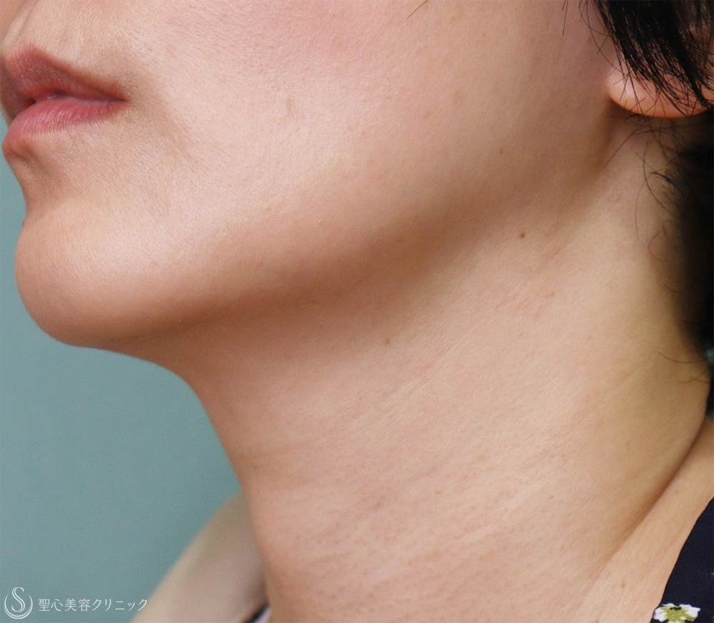 【50代女性・首の横じわ】プレミアムPRP皮膚再生療法（11ヶ月後～5年後） After 