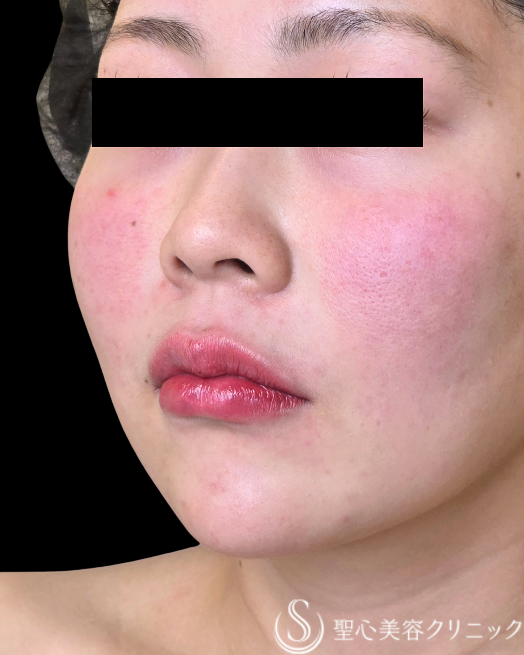 【30代女性・バランスのよい唇に】ヒアルロン酸注入（術直後） After 