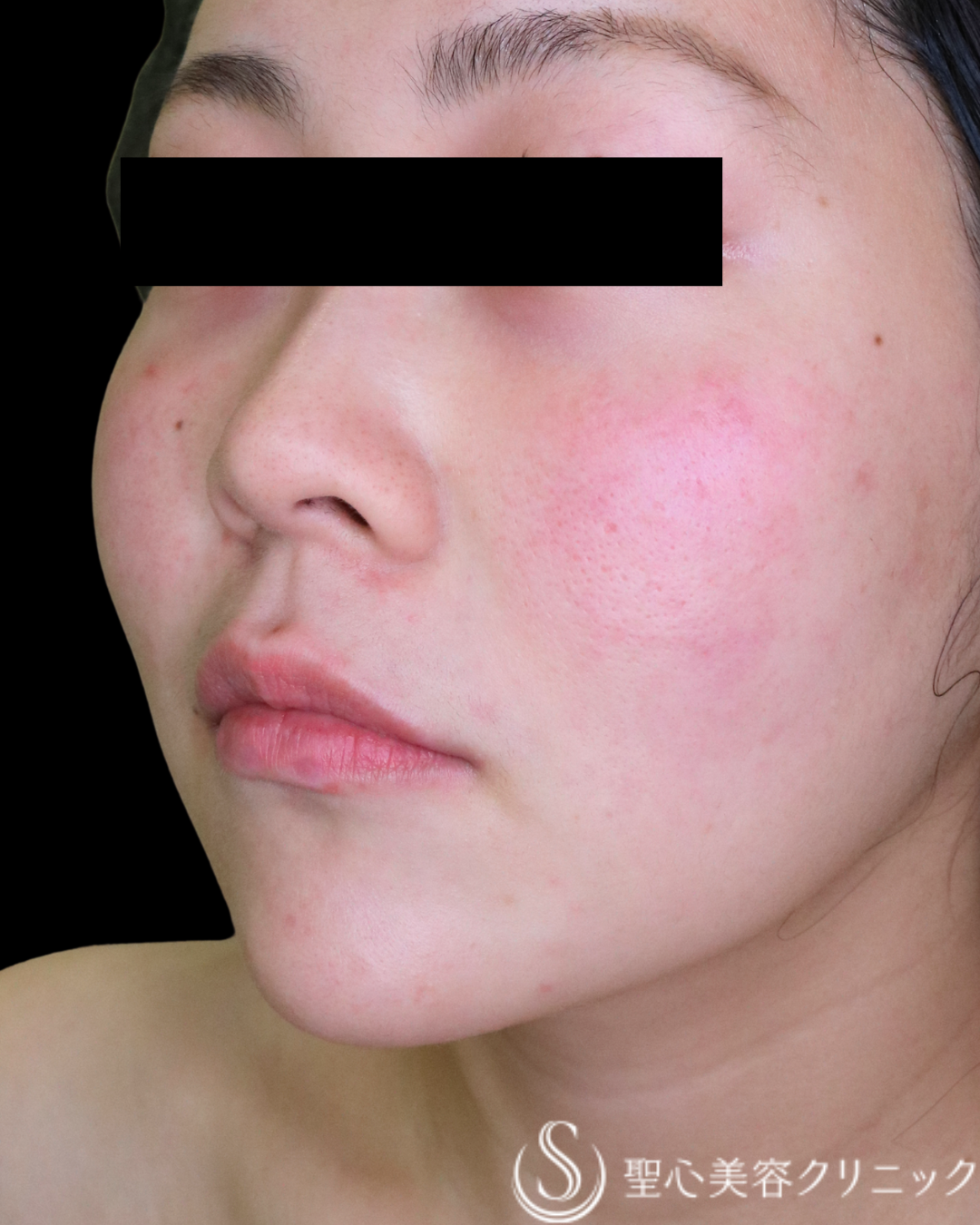 【30代女性・バランスのよい唇に】ヒアルロン酸注入（術直後） Before 