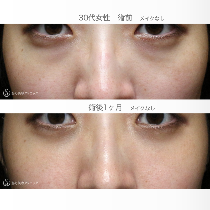【30代女性・目の下のクマ】経結膜下脱脂術 単独（直後〜1ヶ月後） After 