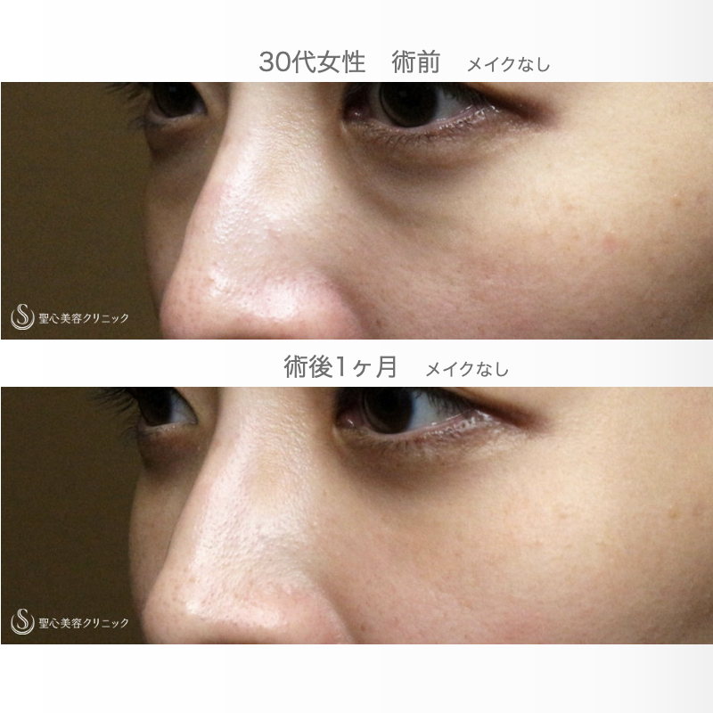【30代女性・目の下のクマ】経結膜下脱脂術 単独（直後〜1ヶ月後） After 