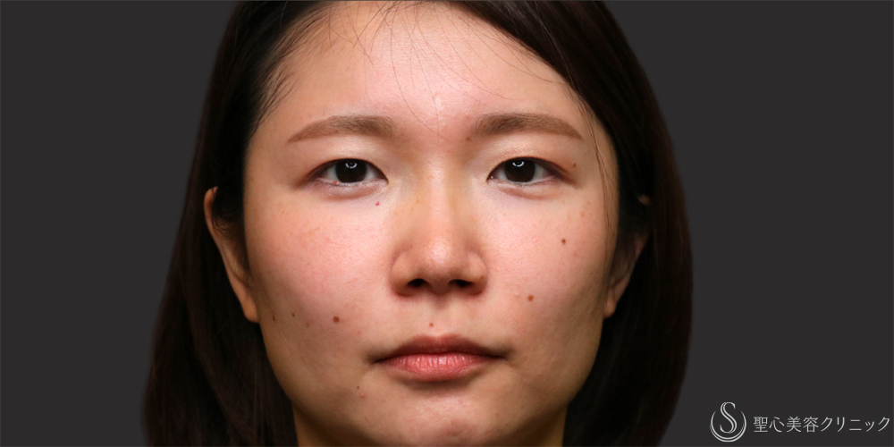 【30代女性・プレミアムPRP皮膚再生療法の長期経過】プレミアムPRP皮膚再生療法（目の下・法令線）（2年11ヶ月後） After 名古屋・クマ治療・目の下のたるみ・アンチエイジング