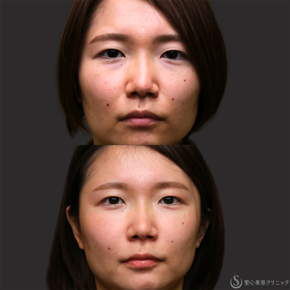【30代女性・プレミアムPRP皮膚再生療法の長期経過】プレミアムPRP皮膚再生療法（目の下・法令線）（2年11ヶ月後） After 名古屋・クマ治療・目の下のたるみ・アンチエイジング