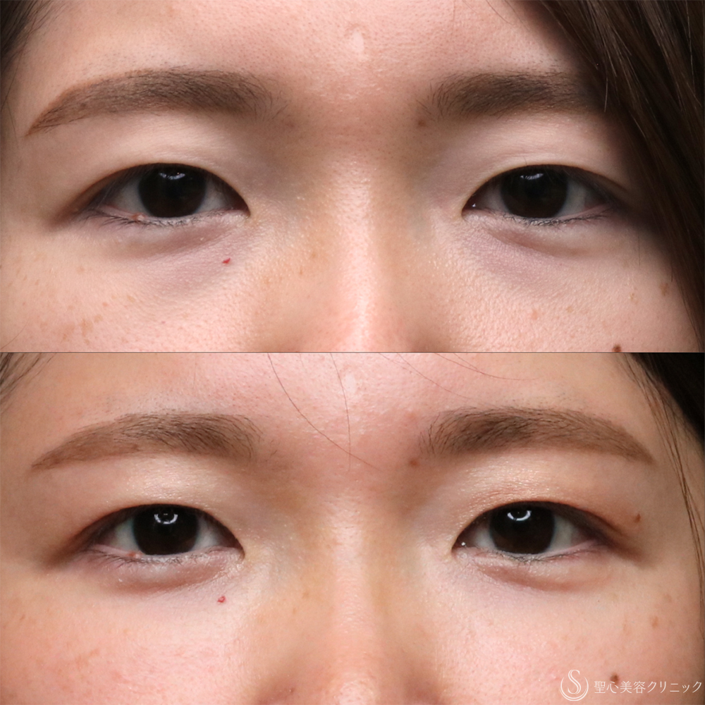 【30代女性・プレミアムPRP皮膚再生療法の長期経過】プレミアムPRP皮膚再生療法（目の下・法令線）（2年11ヶ月後） After 名古屋・クマ治療・目の下のたるみ・アンチエイジング