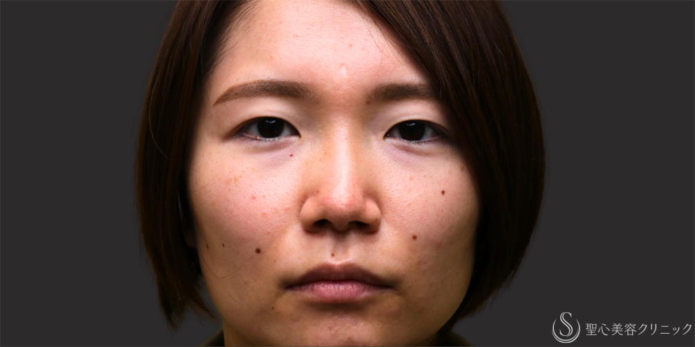 【30代女性・プレミアムPRP皮膚再生療法の長期経過】プレミアムPRP皮膚再生療法（目の下・法令線）（2年11ヶ月後） Before 名古屋・クマ治療・目の下のたるみ・アンチエイジング