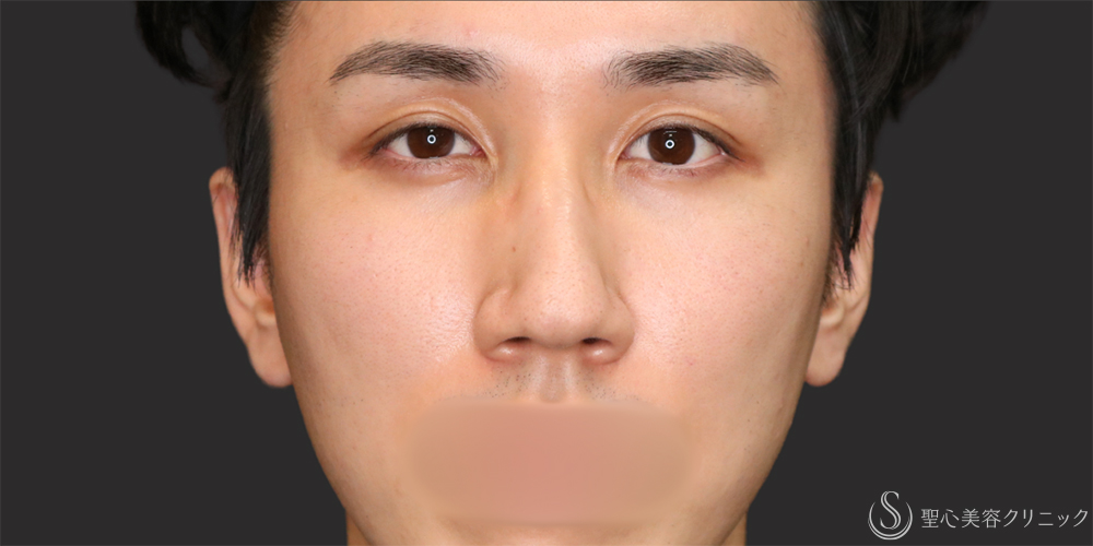【20代男性・ナチュラルな二重で目元の印象アップ】二重埋没法（マイクロメソッド+α）（1ヶ月後） After 名古屋・二重・ぱっちり二重