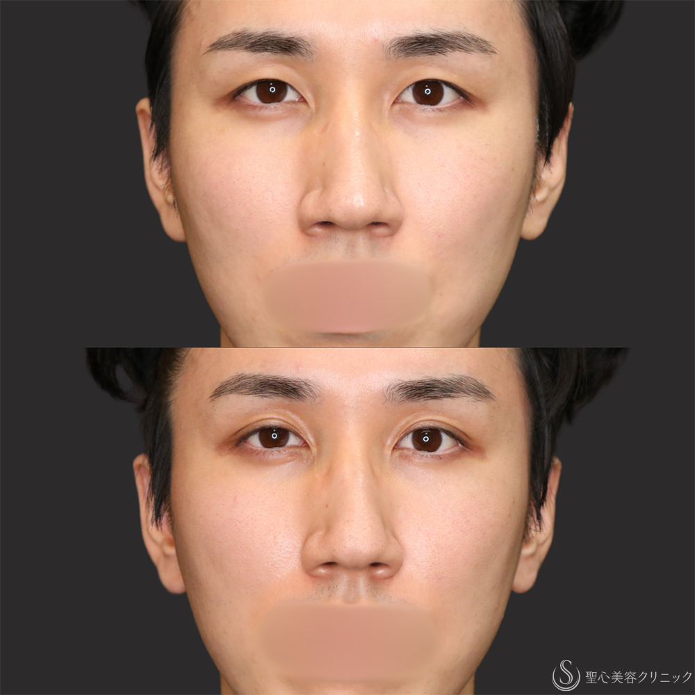 【20代男性・ナチュラルな二重で目元の印象アップ】二重埋没法（マイクロメソッド+α）（1ヶ月後） After 名古屋・二重・ぱっちり二重