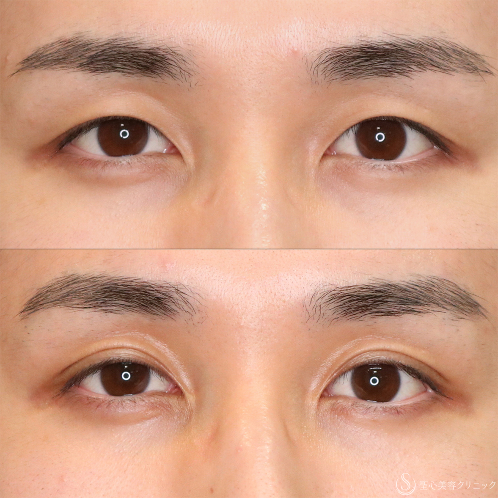 【20代男性・ナチュラルな二重で目元の印象アップ】二重埋没法（マイクロメソッド+α）（1ヶ月後） After 名古屋・二重・ぱっちり二重