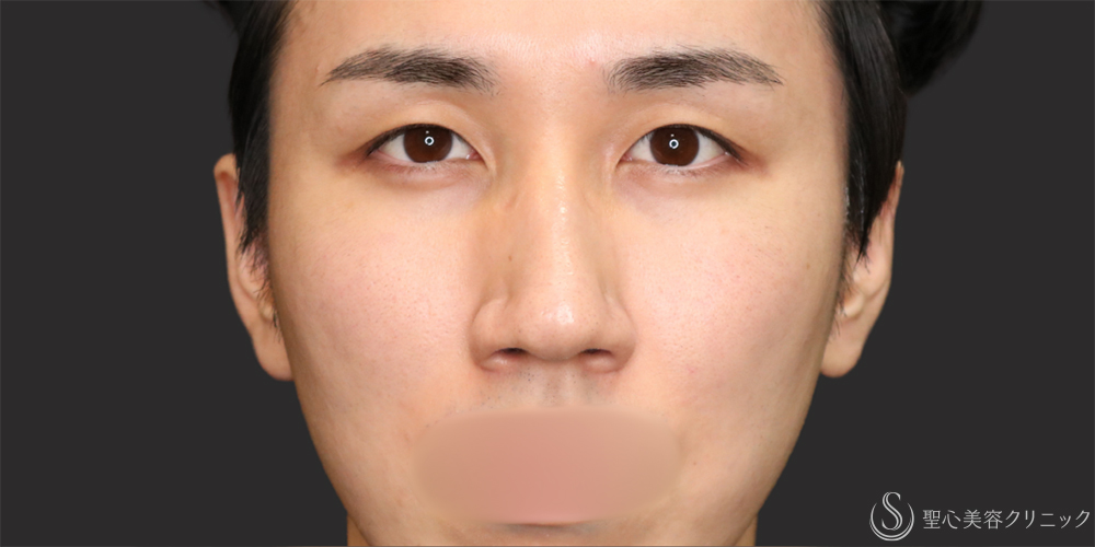 【20代男性・ナチュラルな二重で目元の印象アップ】二重埋没法（マイクロメソッド+α）（1ヶ月後） Before 名古屋・二重・ぱっちり二重
