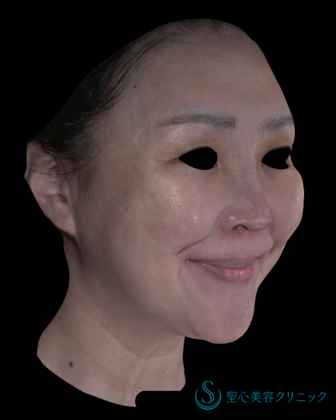 【60代女性・小顔できれいな笑顔に】ワンダーフェイスプロ（1週間後） Before 