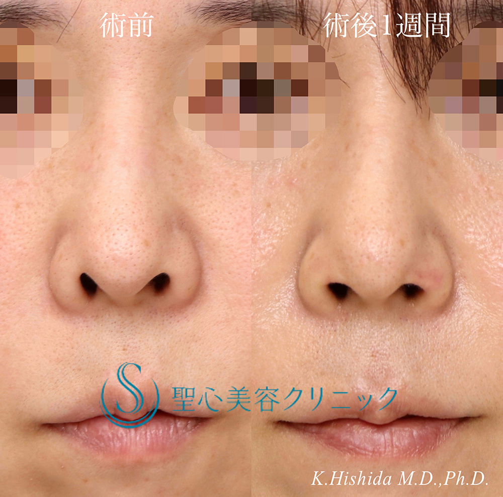【40代女性・鼻の穴を目立ちにくくしたい！！】鼻孔縁下降術（1週間後） After 