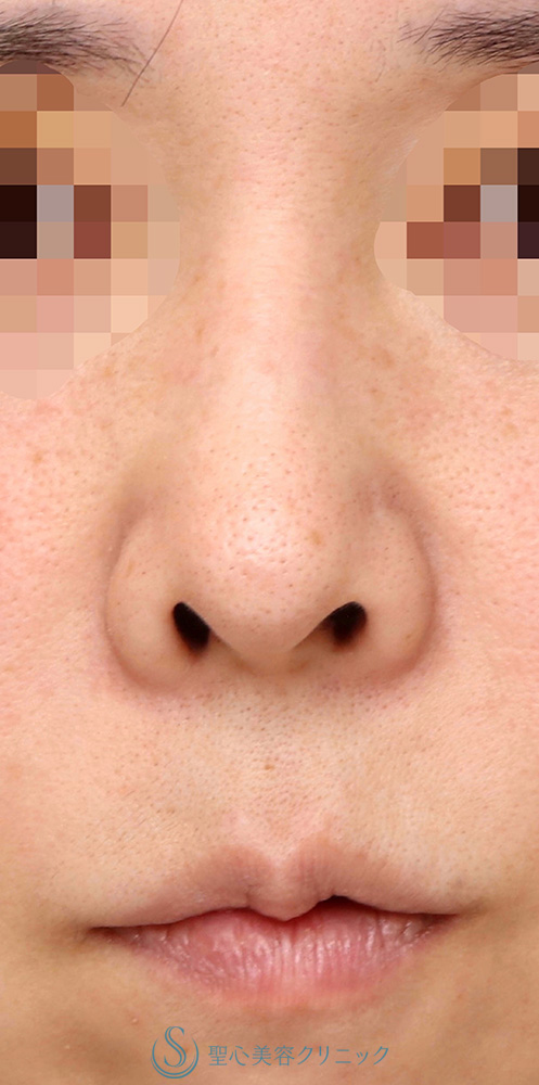 【40代女性・鼻の穴を目立ちにくくしたい！！】鼻孔縁下降術（1週間後） Before 