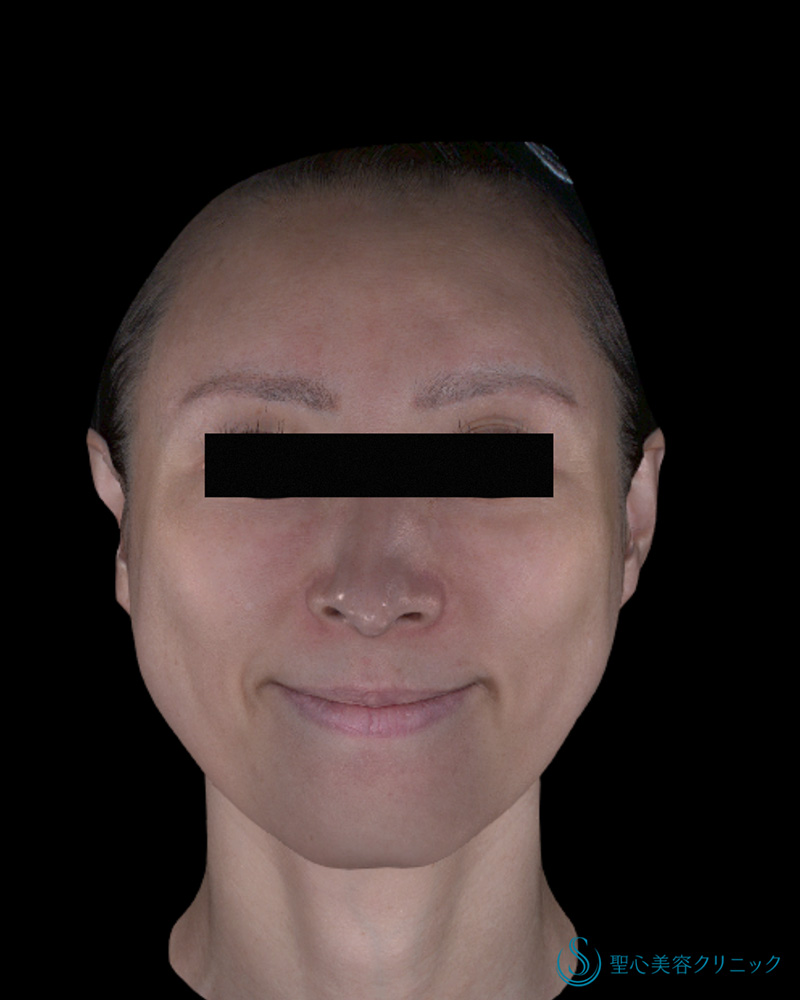 【40代女性・より美しい笑顔で小顔に】ワンダーフェイスプロ＋ボトックスリフト（3回後） Before 