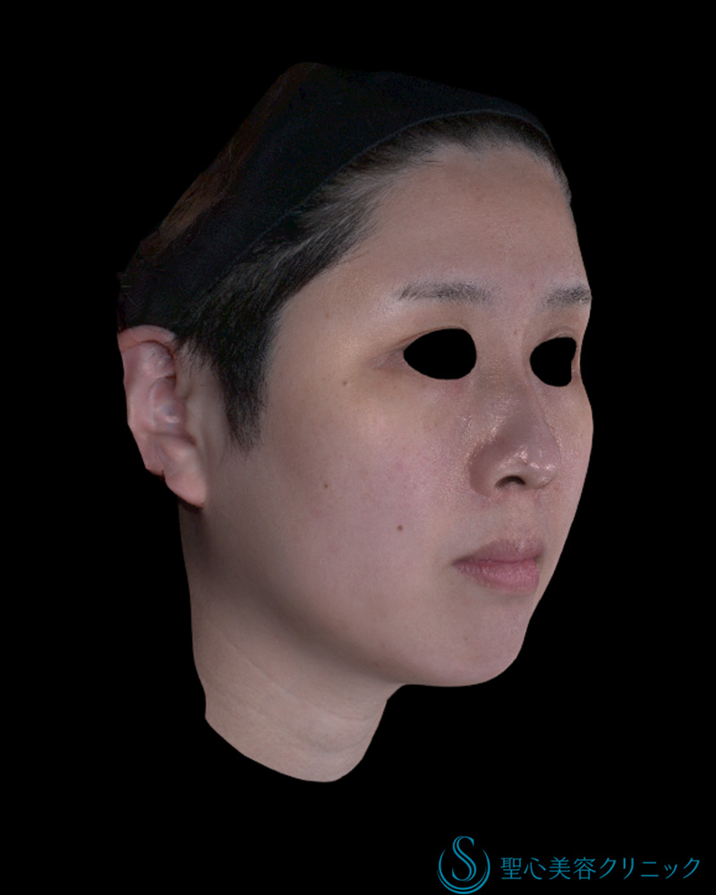 30代女性・筋肉にアプローチして小顔に】ワンダーフェイスプロ（3回後