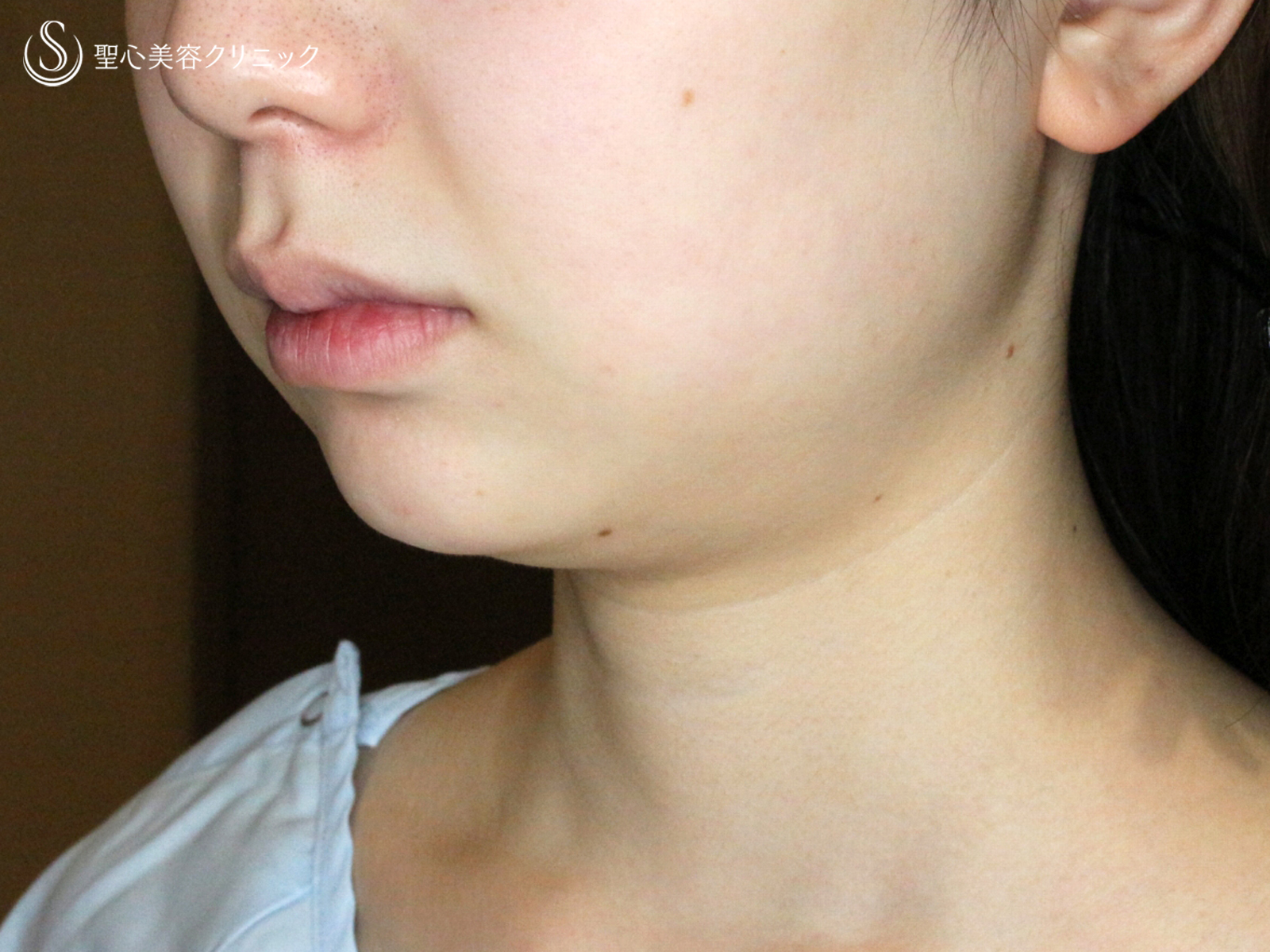 【20代女性・抜群の小顔効果】「あご下」脂肪吸引注射（直後〜1ヶ月後） Before 