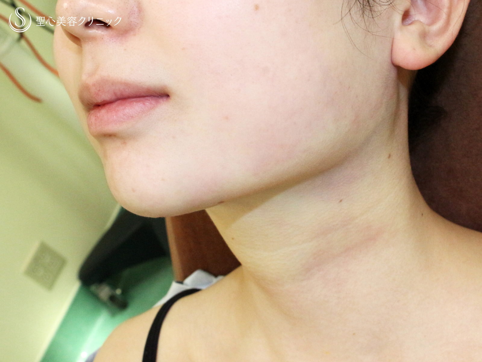 【20代女性・抜群の小顔効果】「あご下」脂肪吸引注射（直後〜1ヶ月後） Before 